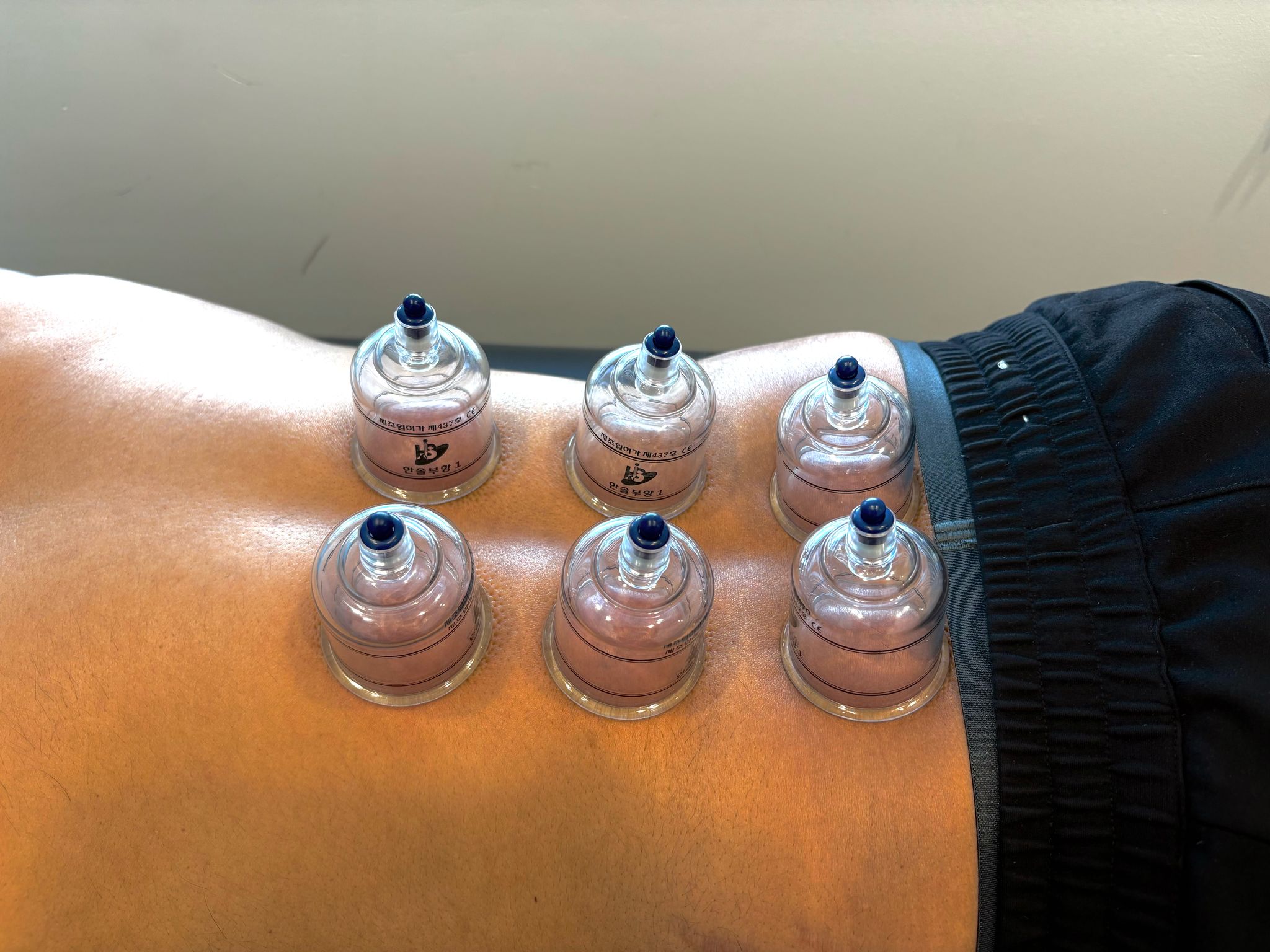 Cupping therapy