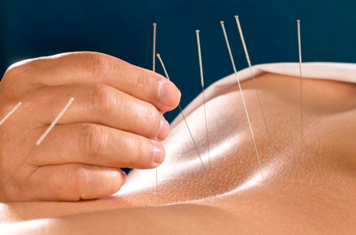 Dry Needling / IMS service