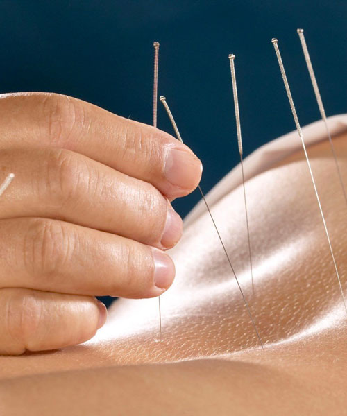 A Person Having Dry Needling Therapy For His Back Pain